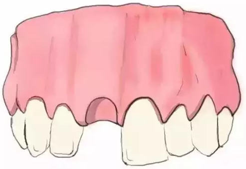 圖解：種牙與鑲牙的區別，缺牙的趕緊看.png