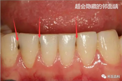 牙縫間的黑線是鄰面齲，還一壞壞倆，巧用它幫你渡過(guò)一“劫”