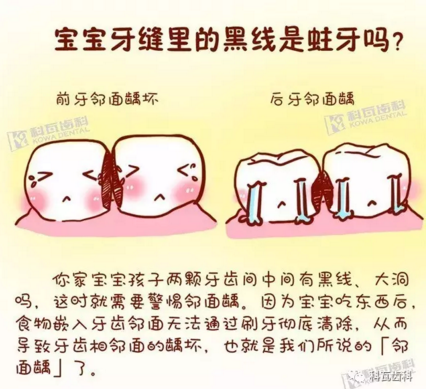 牙縫間的黑線是鄰面齲，還一壞壞倆，巧用它幫你渡過(guò)一“劫”