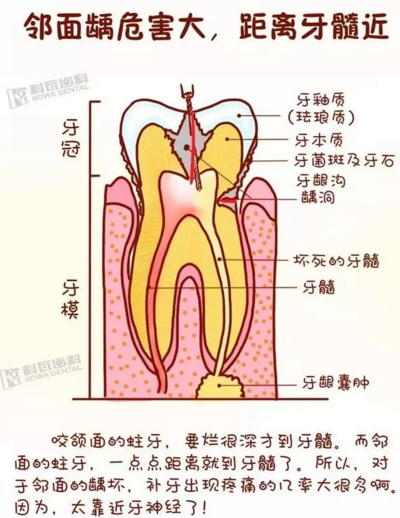牙縫間的黑線是鄰面齲，還一壞壞倆，巧用它幫你渡過(guò)一“劫”
