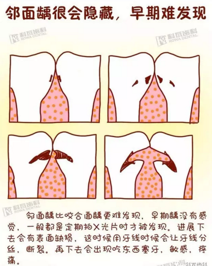 牙縫間的黑線是鄰面齲，還一壞壞倆，巧用它幫你渡過(guò)一“劫”