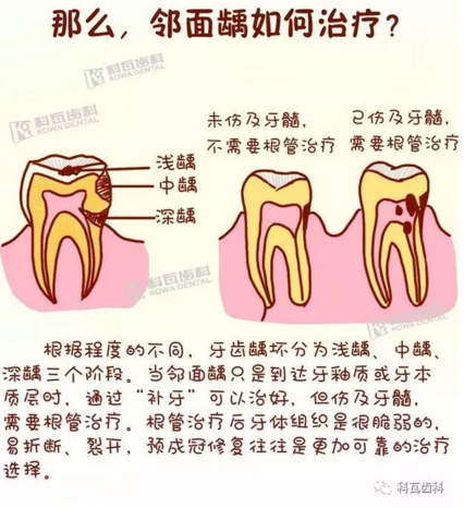 牙縫間的黑線是鄰面齲，還一壞壞倆，巧用它幫你渡過(guò)一“劫”