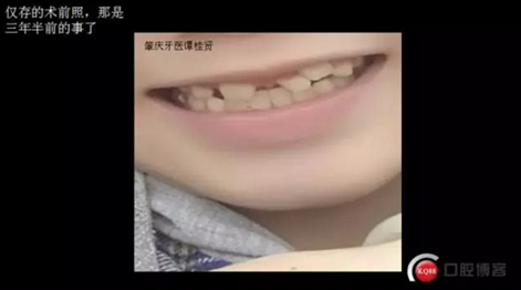 CBCT導(dǎo)航下多生牙拔除，混合牙列期矯正思考！