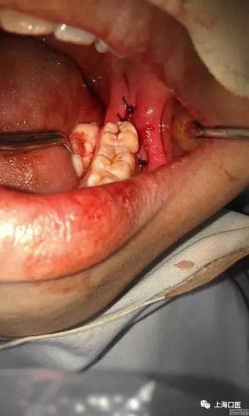 拔牙干槽癥可怕嗎？