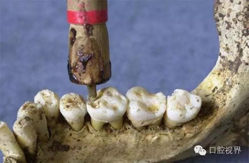以前牙醫(yī)是怎樣虐待人們牙齒的？ 看完了就知道現(xiàn)在看牙多舒適了！