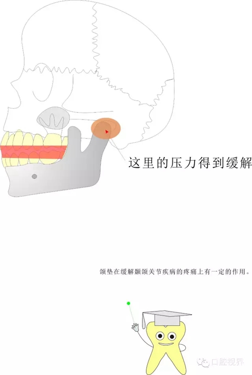 【愛牙科普知識(shí)300問】 “什么是頜（牙）墊？”
