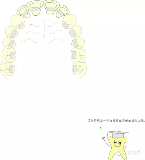 【愛牙科普知識(shí)300問】 “什么是頜（牙）墊？”
