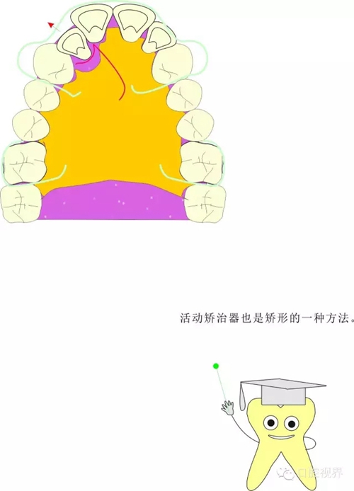 【愛牙科普知識(shí)300問】 “什么是頜（牙）墊？”