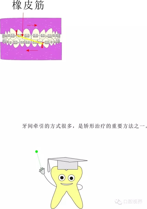 【愛牙科普知識(shí)300問】 “什么是牙間牽引？”