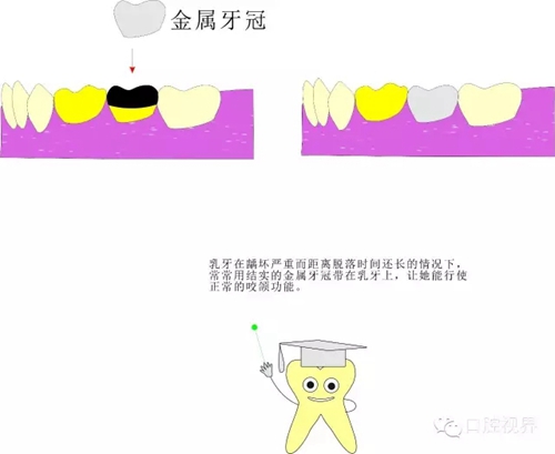 【愛牙科普知識(shí)300問】 “什么是牙間牽引？”
