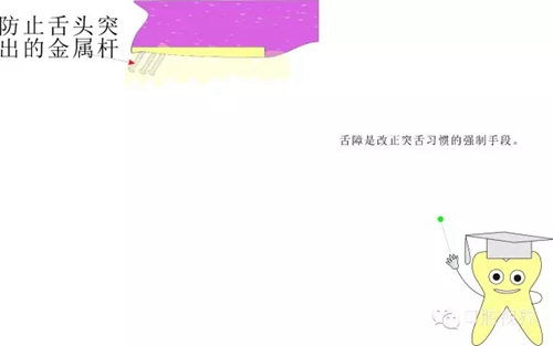 【愛牙科普知識(shí)300問】 “什么是牙間牽引？”