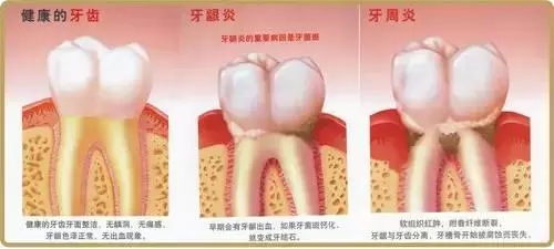 【康雅愛牙科普】牙周炎危害這么大，你咋還不著急呢？