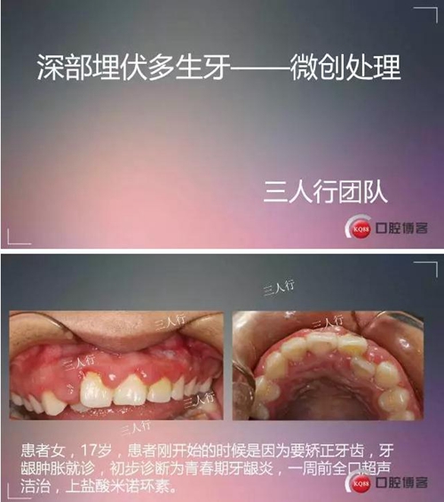 深部埋伏多生牙——微創處理  