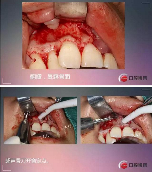 深部埋伏多生牙——微創處理  