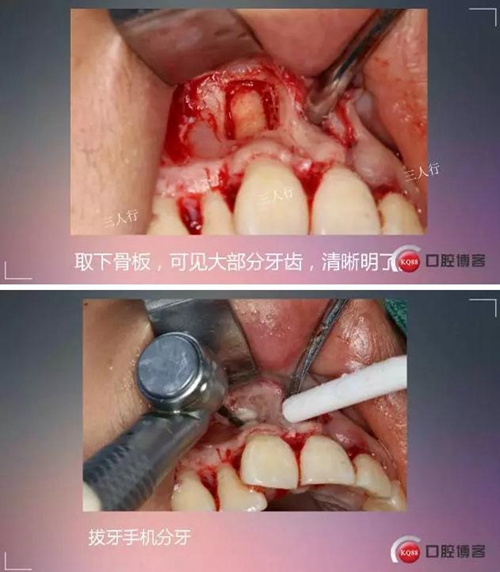 深部埋伏多生牙——微創處理  