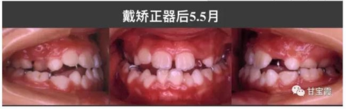 口腔不良習慣會引起牙頜畸形