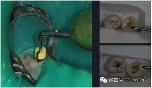 熱牙膠根管填充常見問(wèn)題解答