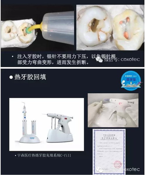 熱牙膠根管填充常見問(wèn)題解答