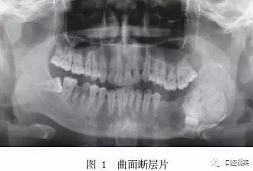 下頜骨骨化纖維瘤并發組合性牙瘤1例