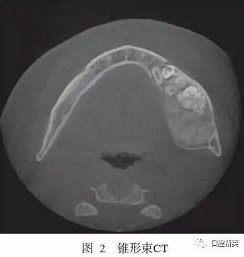 下頜骨骨化纖維瘤并發組合性牙瘤1例