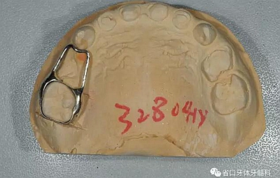 【牙醫學堂】間隙保持器的介紹  