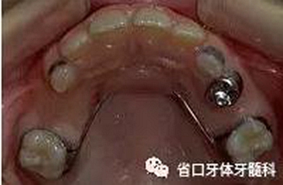 【牙醫學堂】間隙保持器的介紹  