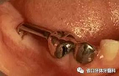 【牙醫學堂】間隙保持器的介紹  