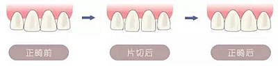 醫生方案里的鄰面去釉，究竟是什么？