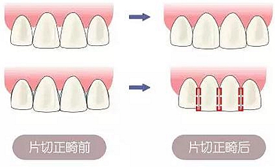 醫生方案里的鄰面去釉，究竟是什么？