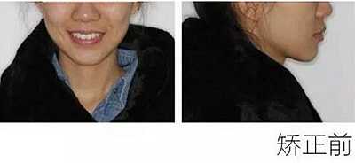 醫生方案里的鄰面去釉，究竟是什么？