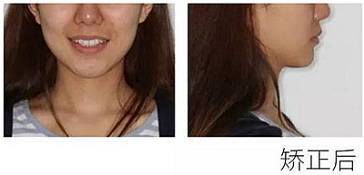 醫生方案里的鄰面去釉，究竟是什么？