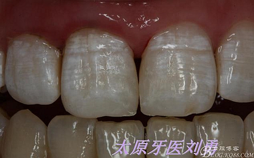 劉勇：斷牙再粘結兩例病例 