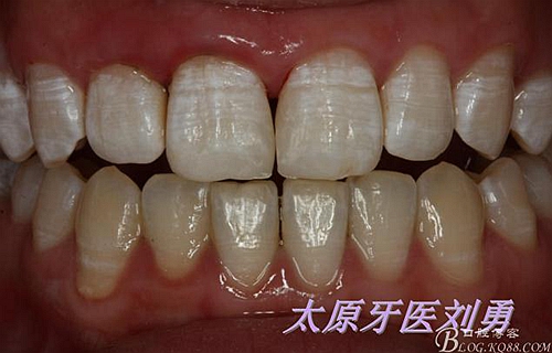 劉勇：斷牙再粘結兩例病例 