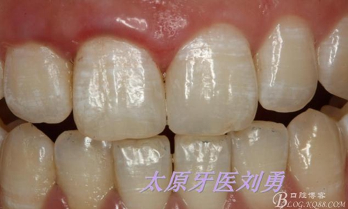 劉勇：斷牙再粘結兩例病例 