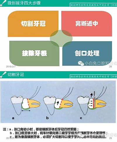 (原創(chuàng))//圖解微創(chuàng)舒適拔牙全過程 