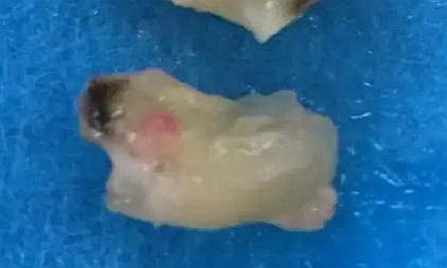 拔牙斷根的去與留？
