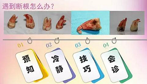 拔牙斷根的去與留？