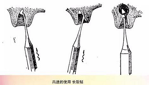 拔牙斷根的去與留？