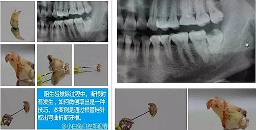 拔牙斷根的去與留？