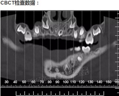 多生牙的拔除總原則：早發(fā)現(xiàn)，早處理！