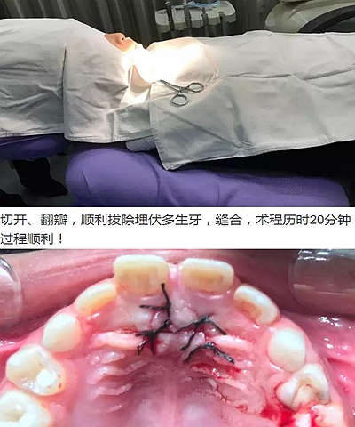 多生牙的拔除總原則：早發(fā)現(xiàn)，早處理！