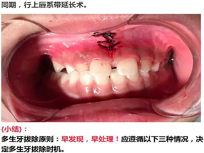 多生牙的拔除總原則：早發(fā)現(xiàn)，早處理！