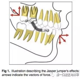 正畸文獻閱讀--用Jasper跳躍矯治器治療II類患者的長期穩定性