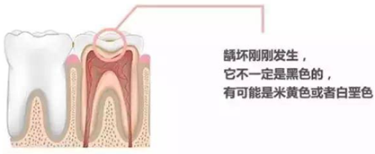 【收藏】關于補牙，知道這些就夠了！