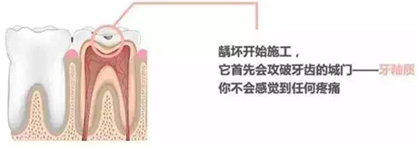 【收藏】關于補牙，知道這些就夠了！