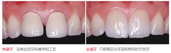 醫(yī)生，我的烤瓷牙上有個黑線怎么回事？