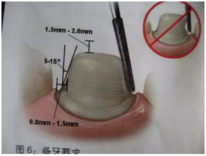 醫(yī)生，我的烤瓷牙上有個黑線怎么回事？