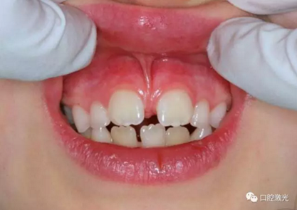 【案例】口腔激光輔助兒童口腔系帶整形概述在兒童口腔治療中，最大的挑戰就是兒童對疼痛、治療器械、噪聲以及其他所有陌生事物的恐懼心理。