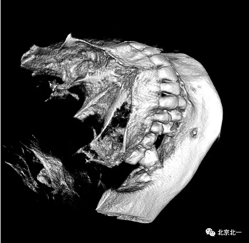 多學科病例分析---正畸、種植、微創拔牙多學科交叉病例