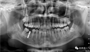 多學科病例分析---正畸、種植、微創拔牙多學科交叉病例